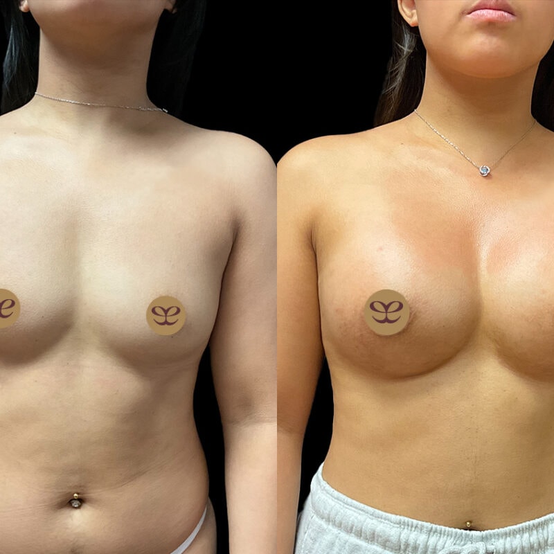 Breast augmentation before after, front view.