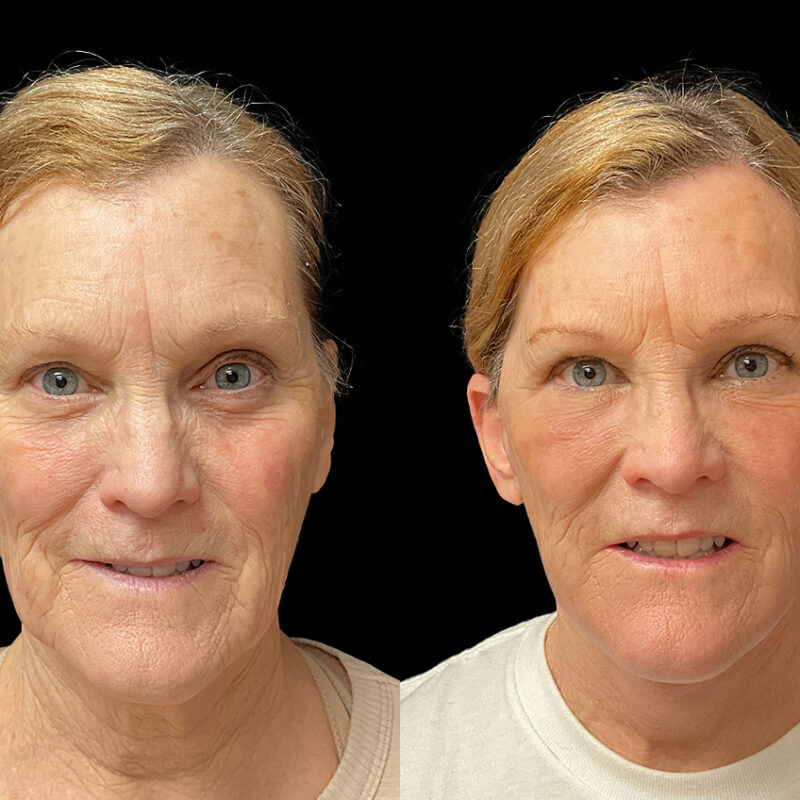 Before and after photo of patient after a facelift and necklift