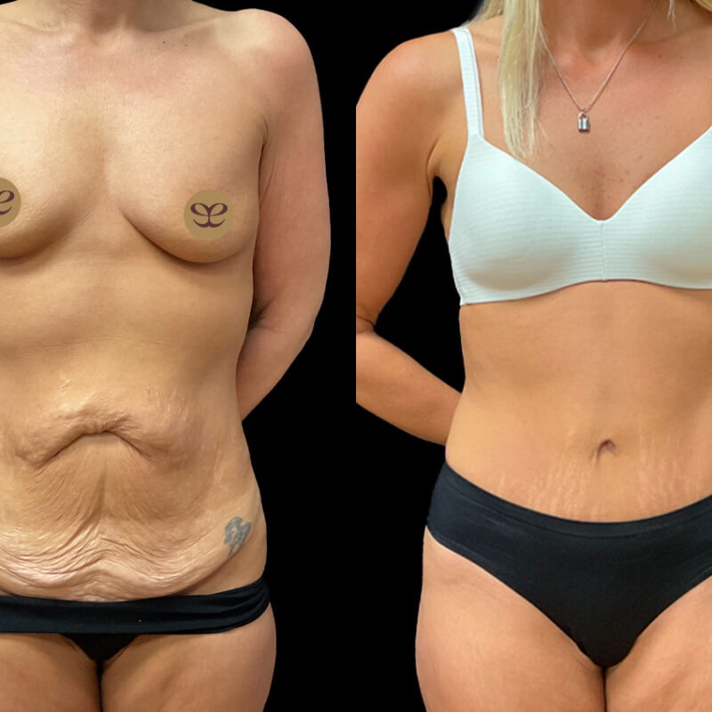 Before and after photo showing the results of an abdominoplasty, front view.