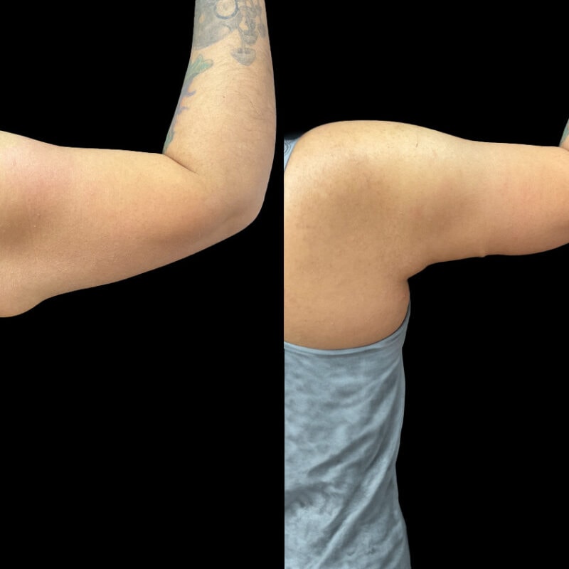 Before and after photo showing results of arm lift or brachioplasty