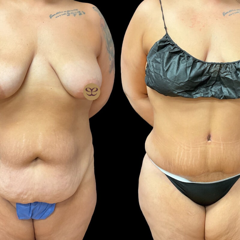 Evolve Your Life before and after tummy tuck