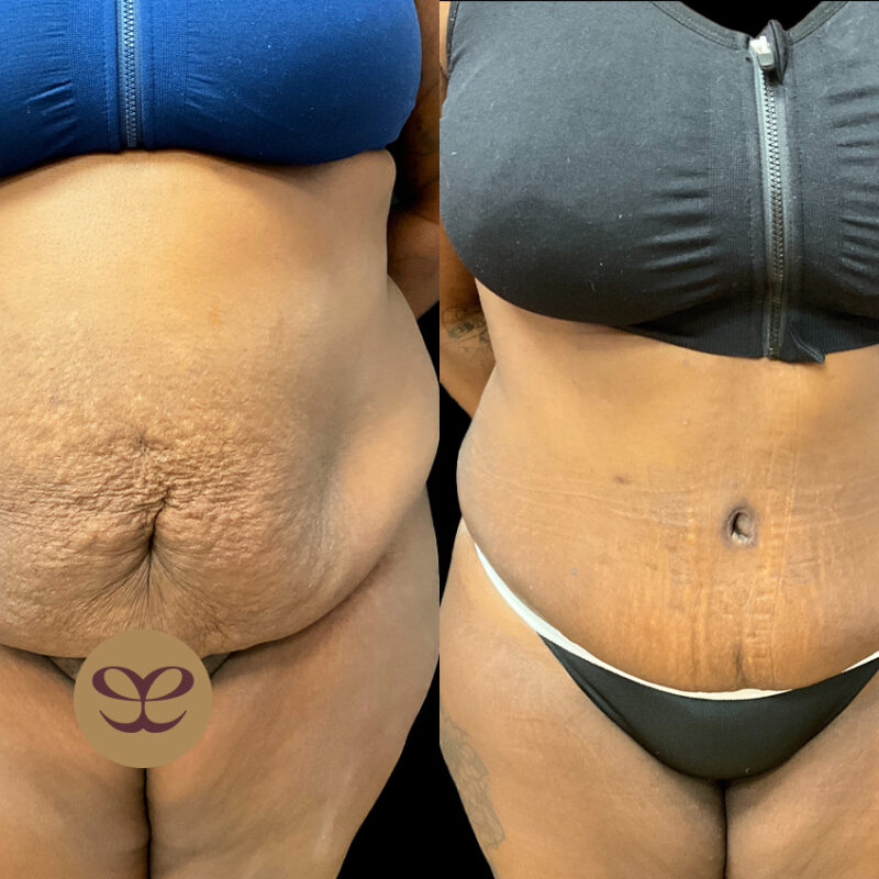Evolve Your Life before and after tummy tuck