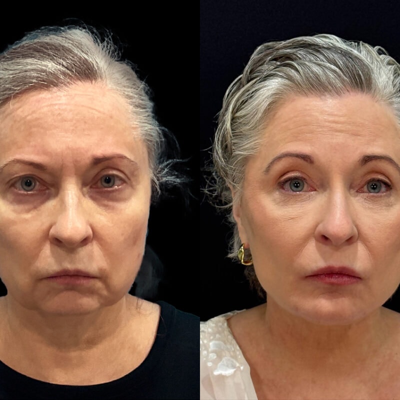 Before and after photo of facial rejuvenation including chin, eyes, and facelift, front view.