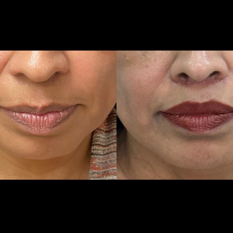 Evolve Your Life before and after lip lift