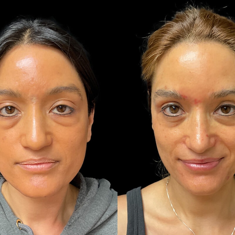 Before and after photo of rhinoplasty, commonly known as a nose job, front view.