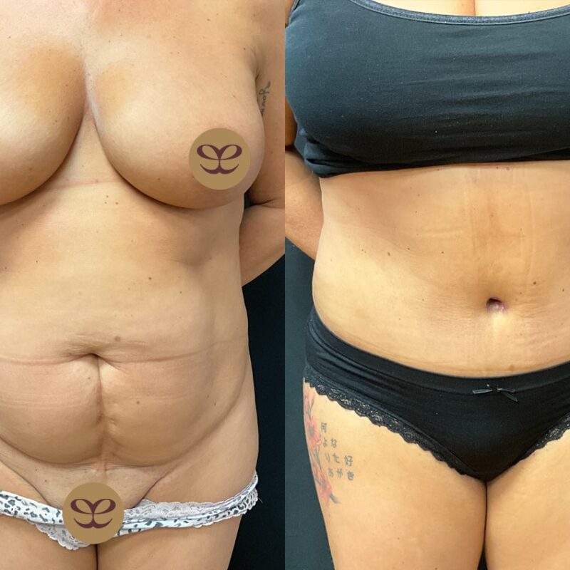 Evolve Your Life before and after tummy tuck