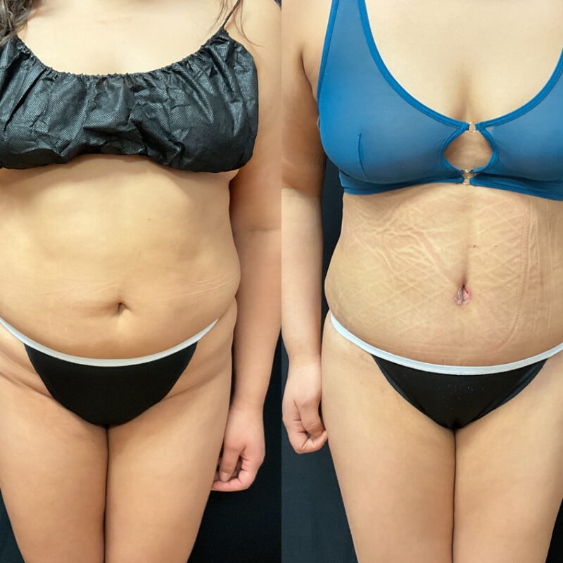 Evolve Your Life before and after tummy tuck