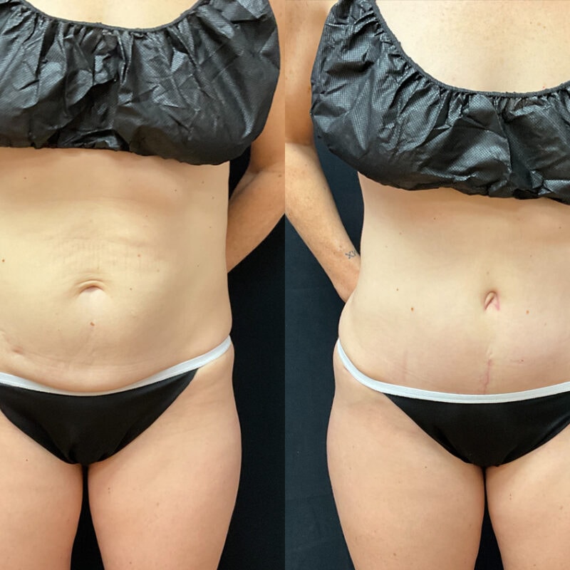 Evolve Your Life before and after tummy tuck