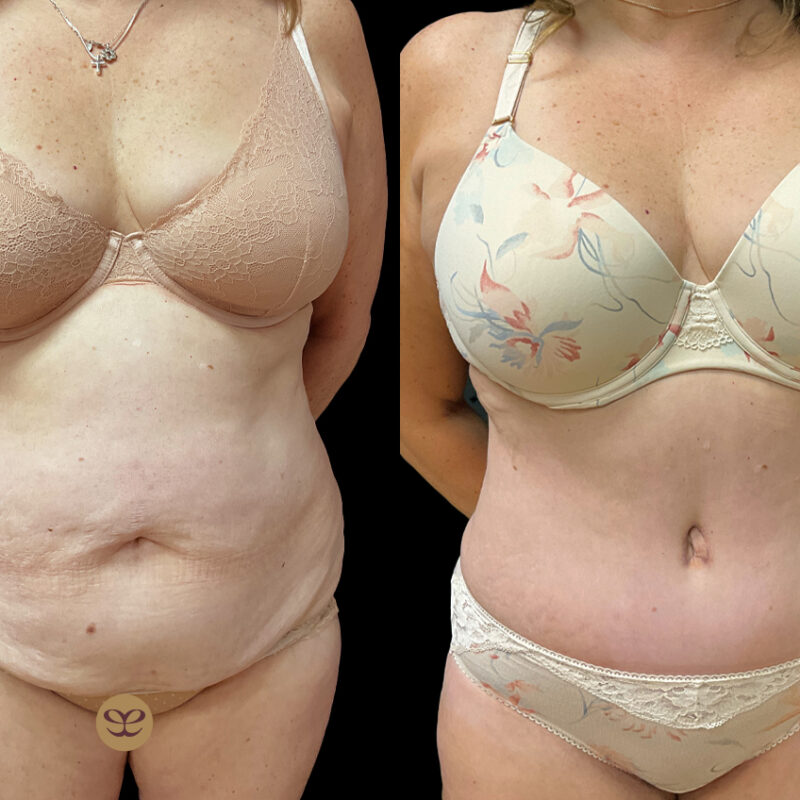 Evolve Your Life before and after tummy tuck