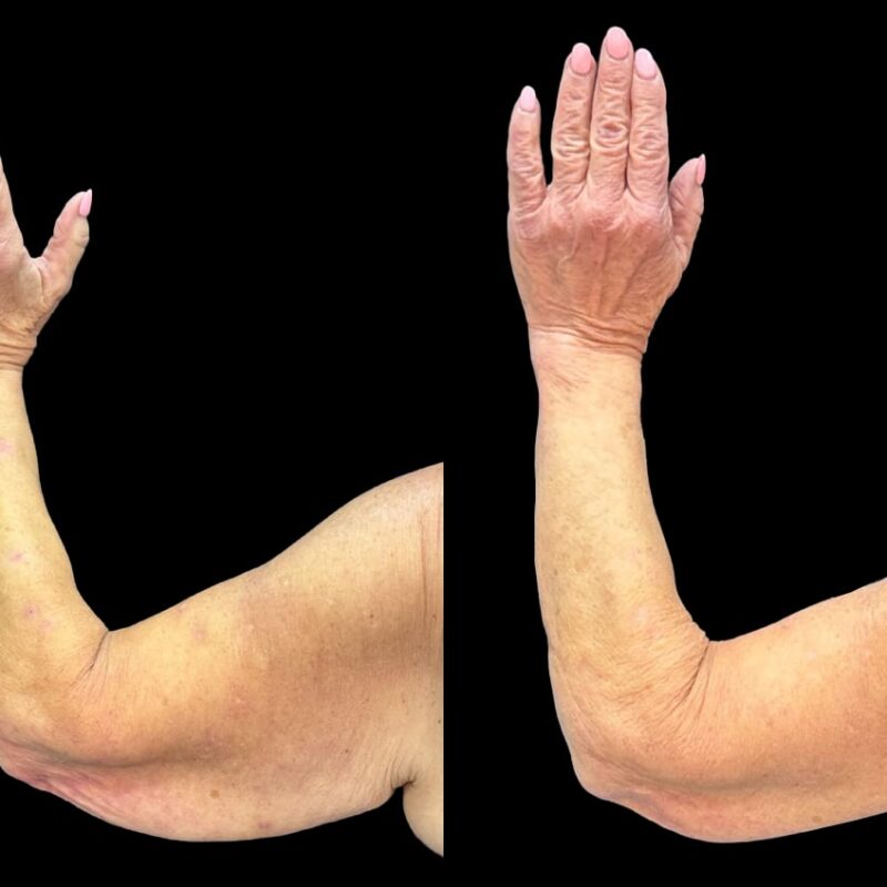 Evolve Your Life before and after arm lift