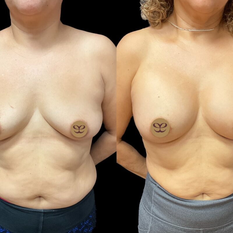 Evolve Your Life before and after breast augmentation