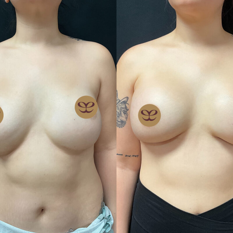 Evolve Your Life before and after breast augmentation