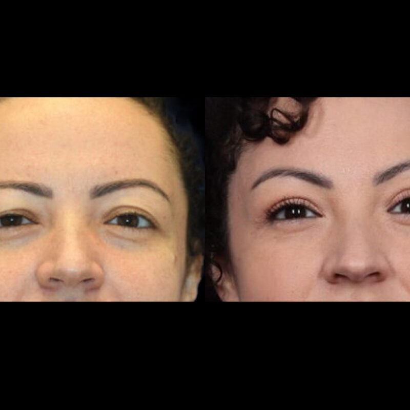 Evolve Your Life before and after blepharoplasty