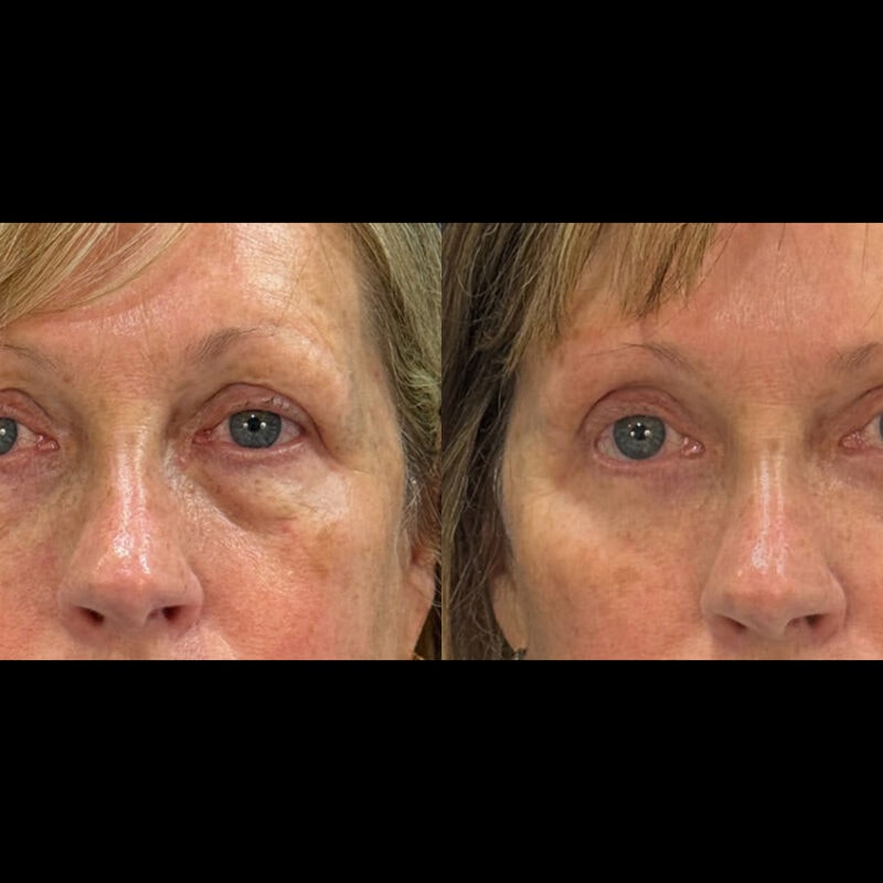 Evolve Your Life before and after eyelid lift
