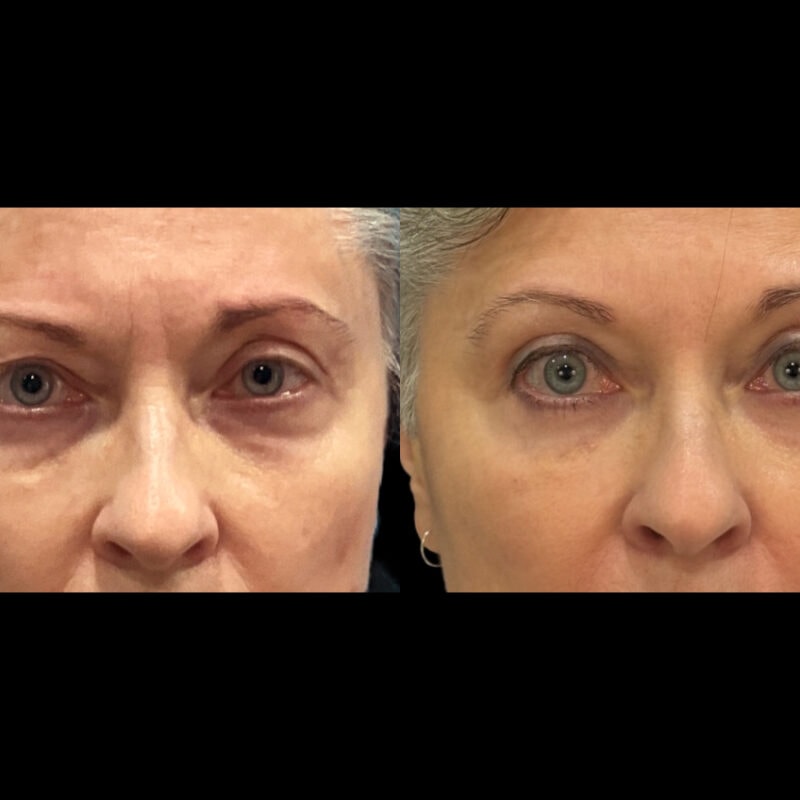 Evolve Your Life before and after eyelid lift