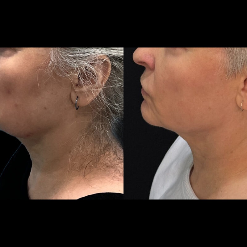 Evolve Your Life before and after chin lift