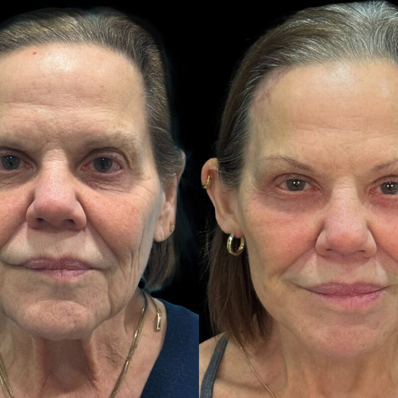 Evolve Your Life before and after facelift
