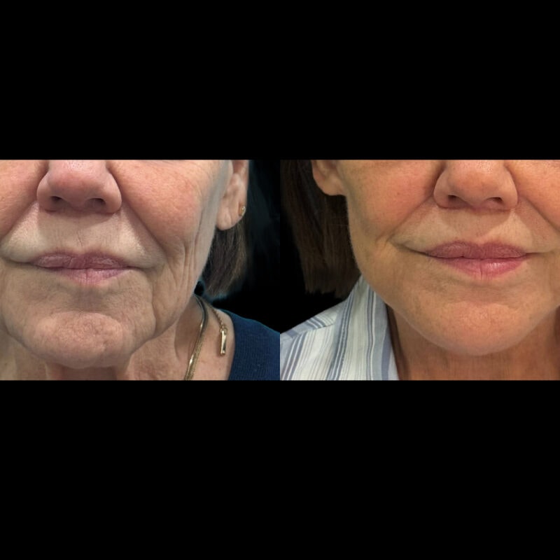 Evolve Your Life before and after lip lift