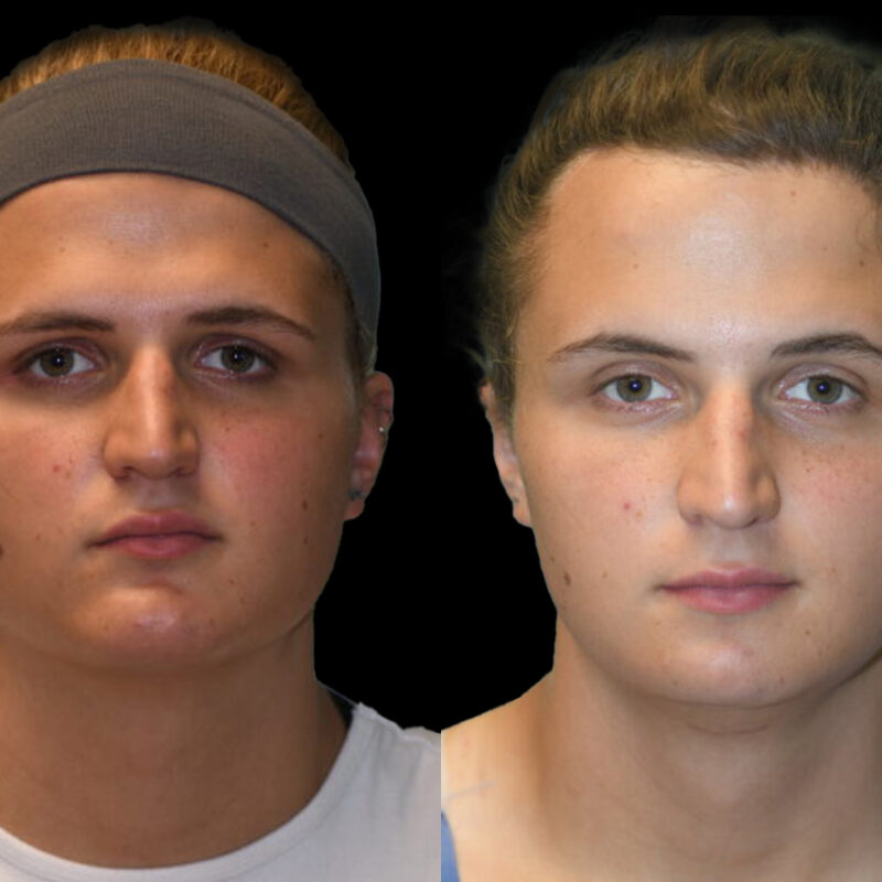 Evolve Your Life before and after gender affirmation