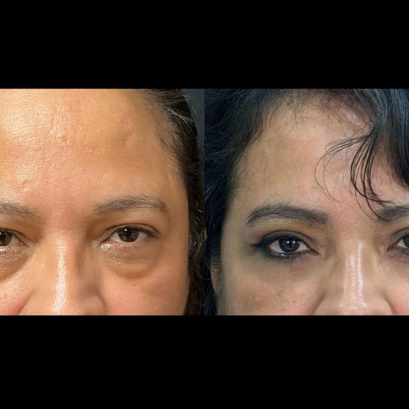 Evolve Your Life before and after brow and eyelid lift