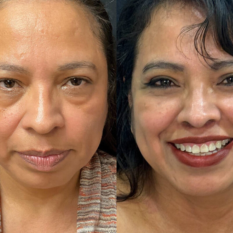Evolve Your Life before and after facelift