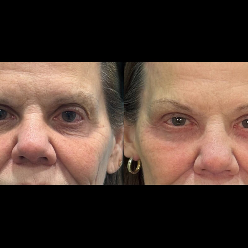 Evolve Your Life before and after brow and eyelid lift