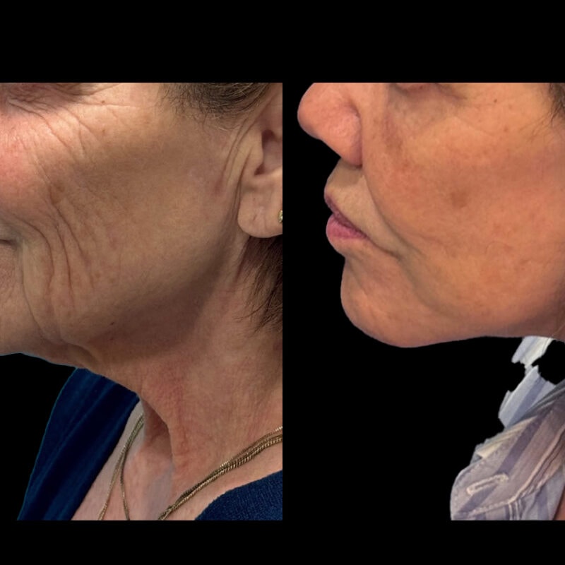 Evolve Your Life before and after neck lift