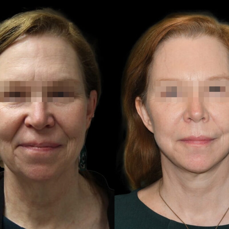 Evolve Your Life before and after facelift