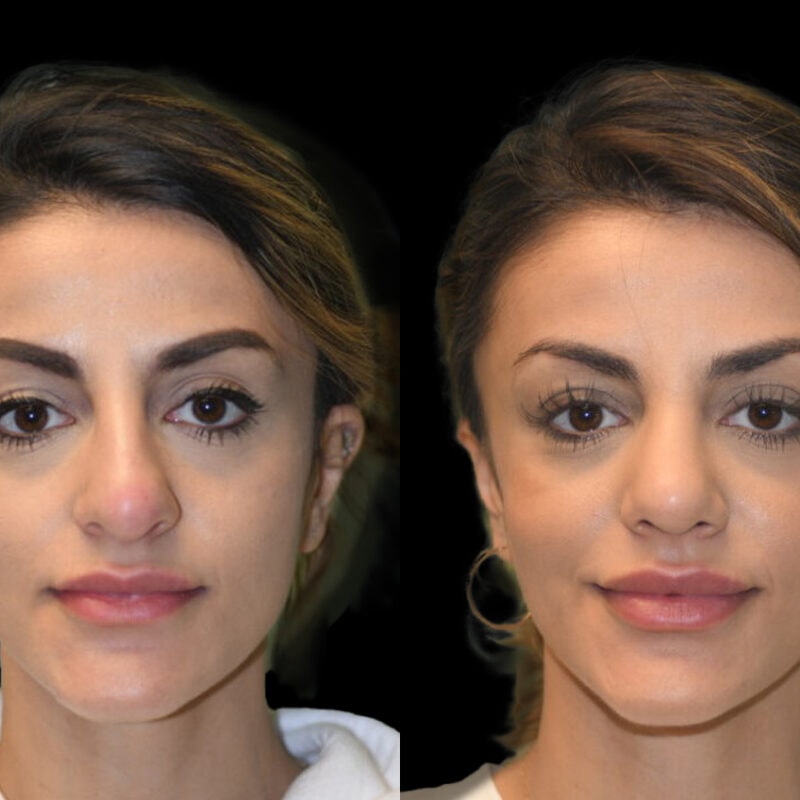 Evolve Your Life before and after rhinoplasty