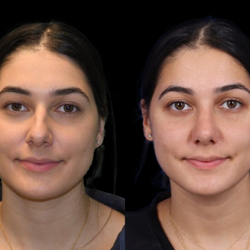 Evolve Your Life before and after rhinoplasty
