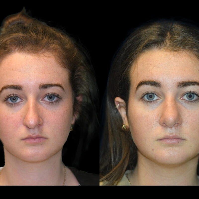 Evolve Your Life before and after rhinoplasty