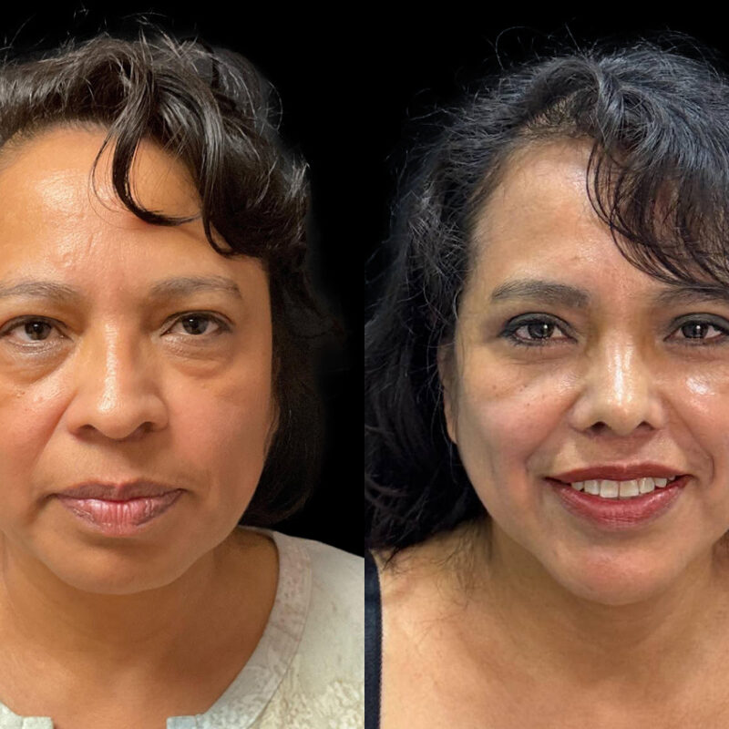 Evolve Your Life before and after rhinoplasty