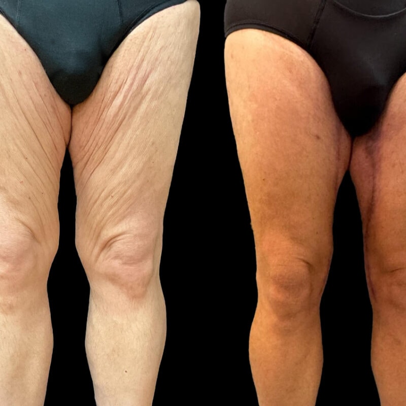 Evolve Your Life before and after thigh lift