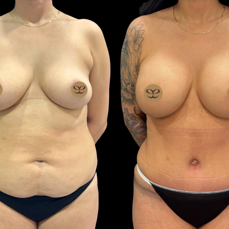 Evolve Your Life before and after mommy makeover