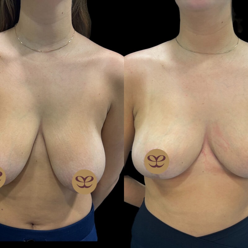 Evolve Your Life before and after breast lift