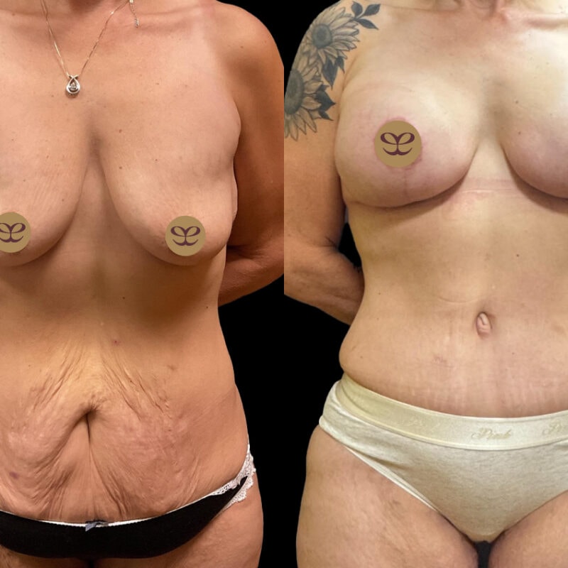 Evolve Your Life before and after breast lift