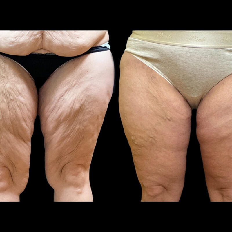 Evolve Your Life before and after thigh lift