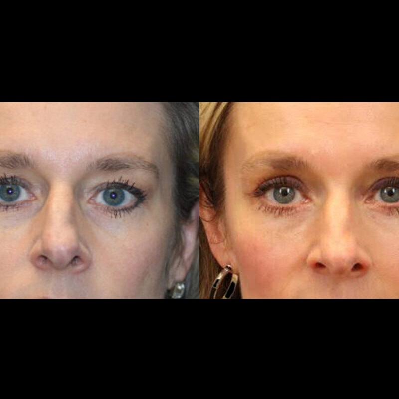 Evolve Your Life before and after blepharoplasty