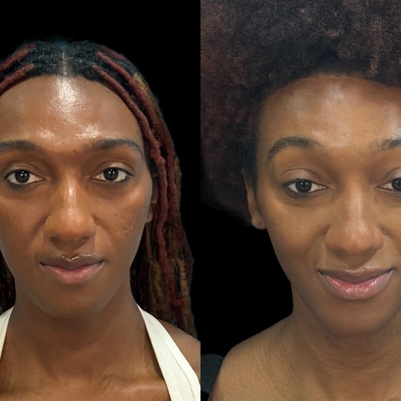 Evolve Your Life before and after gender affirmation