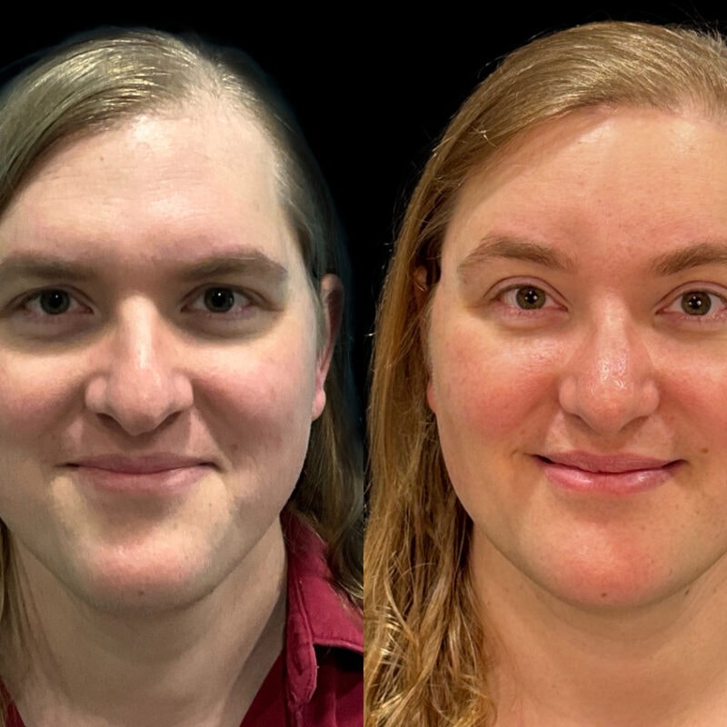 Evolve Your Life before and after gender affirmation