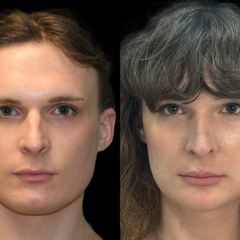 Evolve Your Life before and after gender affirmation