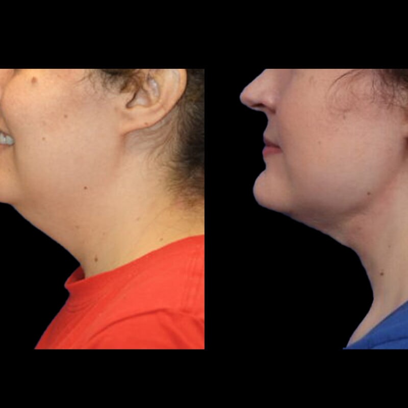 Evolve Your Life before and after neck lift
