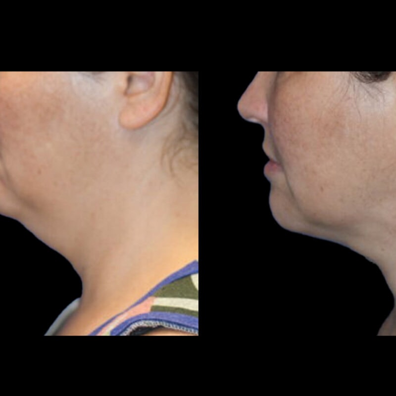 Evolve Your Life before and after neck lift