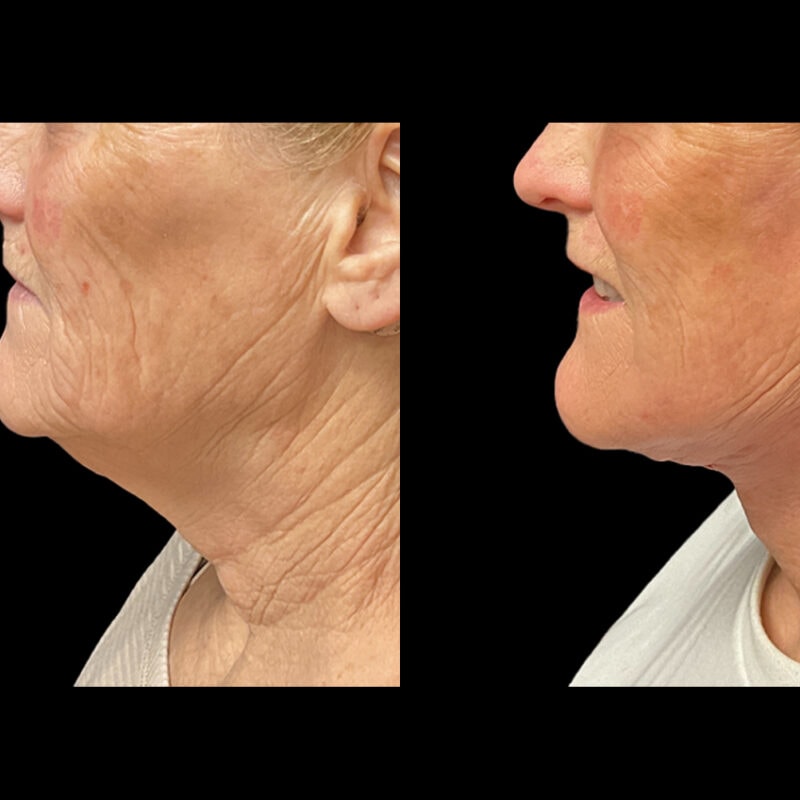 Evolve Your Life before and after neck lift